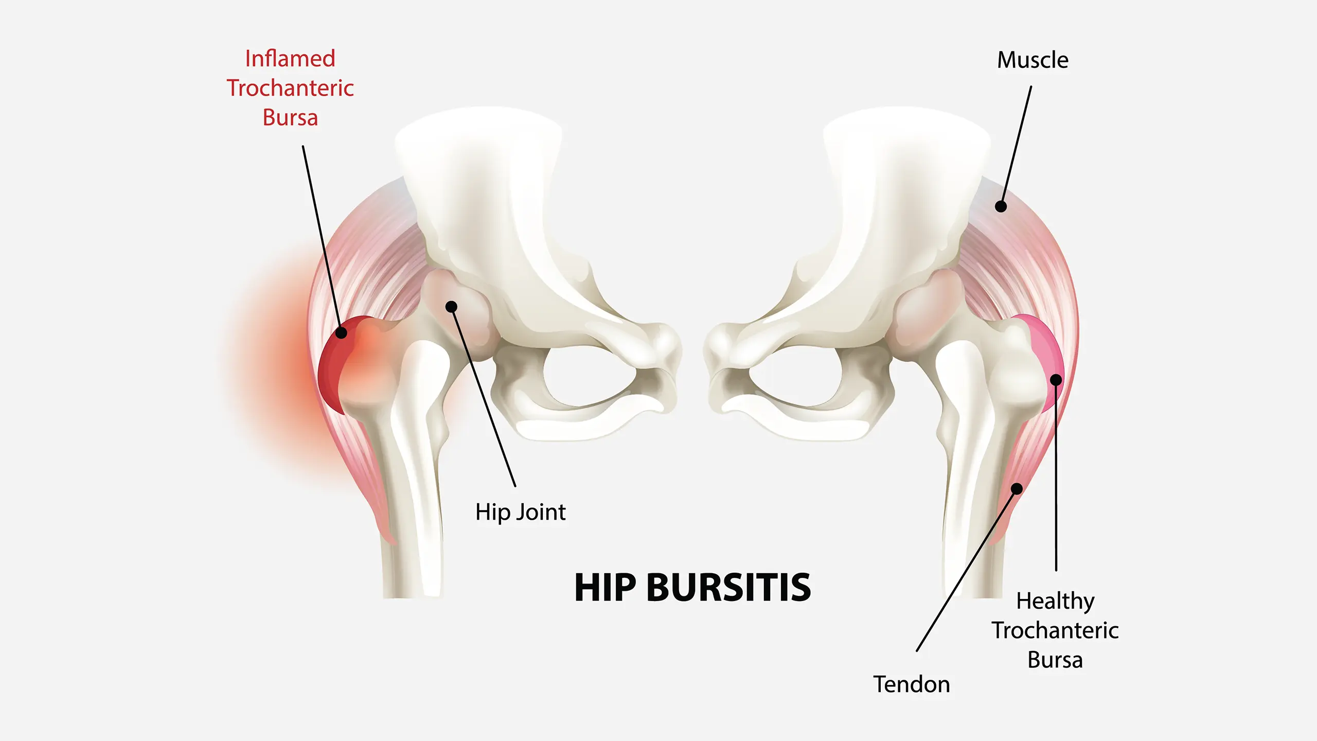 hip bursitis lump img