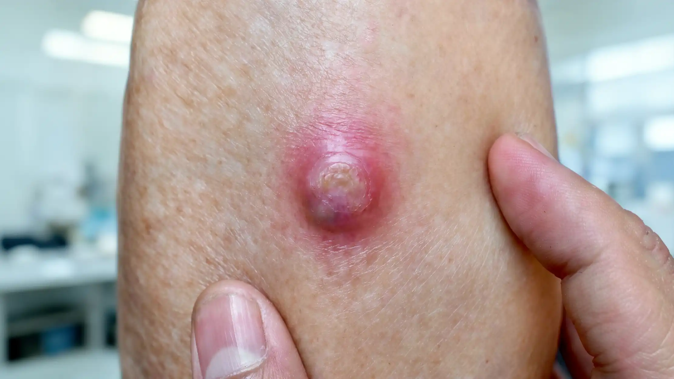 Skin Abscess blog img