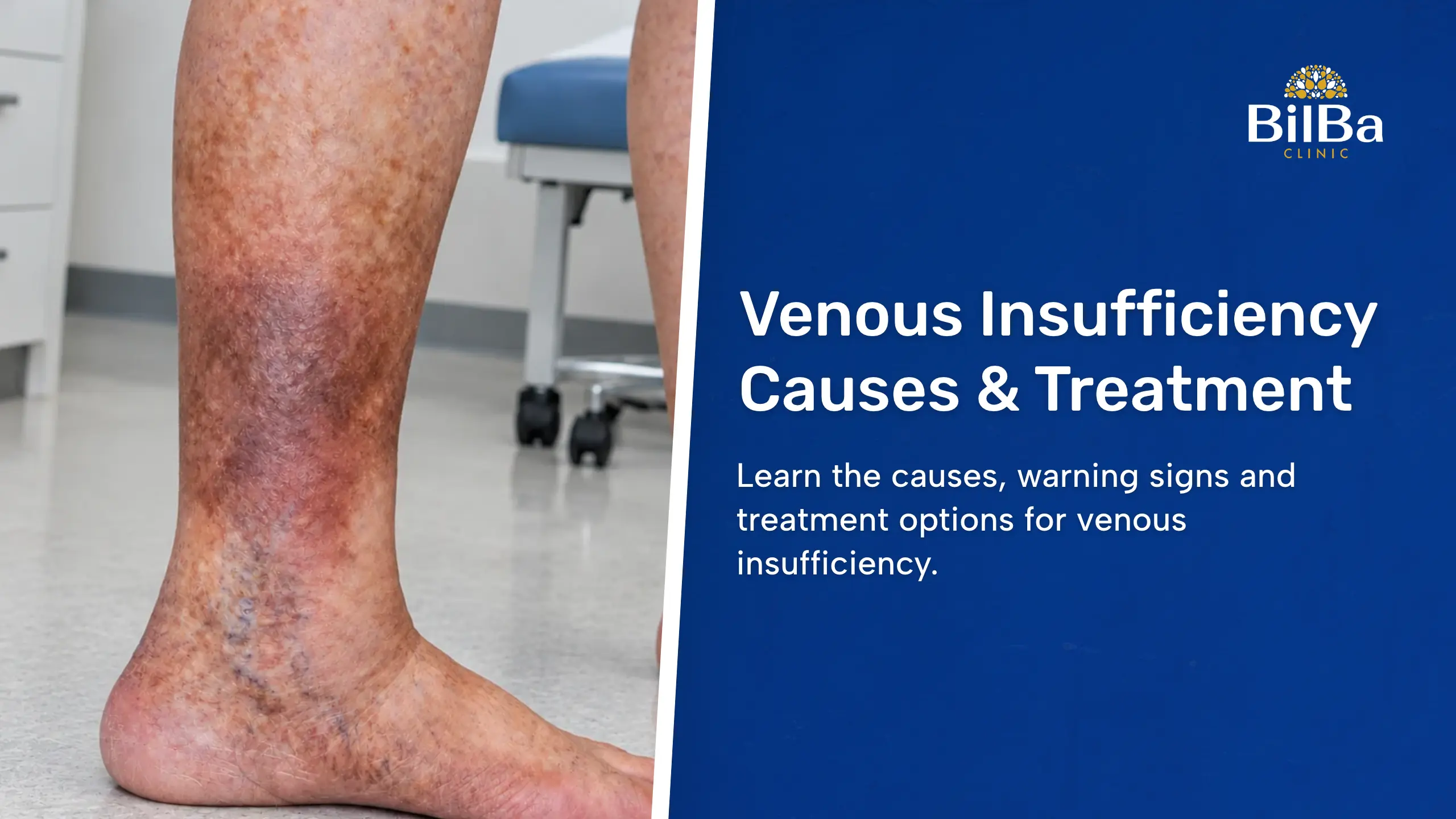 Venous Insufficiency Treatment in London Bilba Clinic